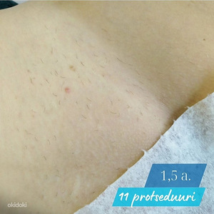 Электроэпиляция (2 фото из 3)