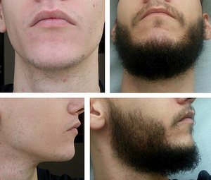 MINOXIDIL 5% Kirkland Signature (4 foto / 4)