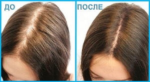 Minoxidil for women (4 foto / 5)