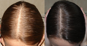 Minoxidil for women (5 foto / 5)