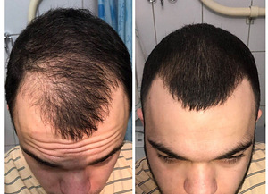 Minoxidil 100% original миноксидил (6 foto / 7)
