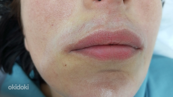 Ասեղային- բիո մազահեռացում Գյումրիում