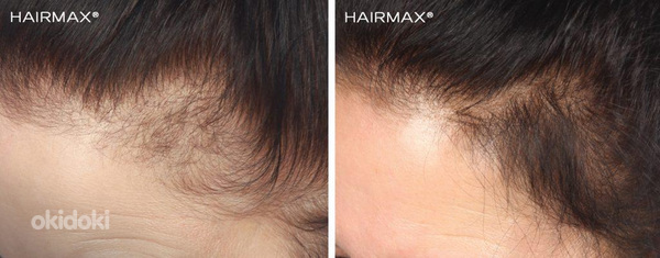Курс против выпадения волос (фото #1)