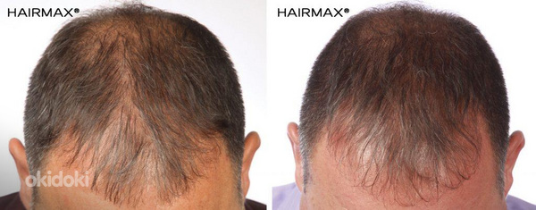 Курс против выпадения волос (фото #3)