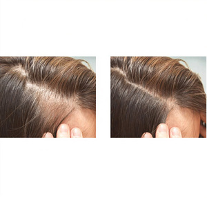 FOLIGAIN Minoxidil 2% juuste kasvu toode naistele (8 foto / 8)
