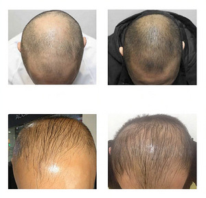 VAHT | FOLIGAIN Minoxidil 5% Juuste kasvu vaht meestele (5 foto / 5)
