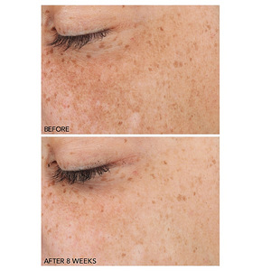 Dr Dennis gross dark spots (2 foto / 4)