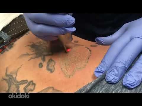 Tattoo eemaldamise laser (foto #3)